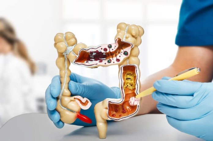 Tumori, luci e ombre per screening colorettali in Molise